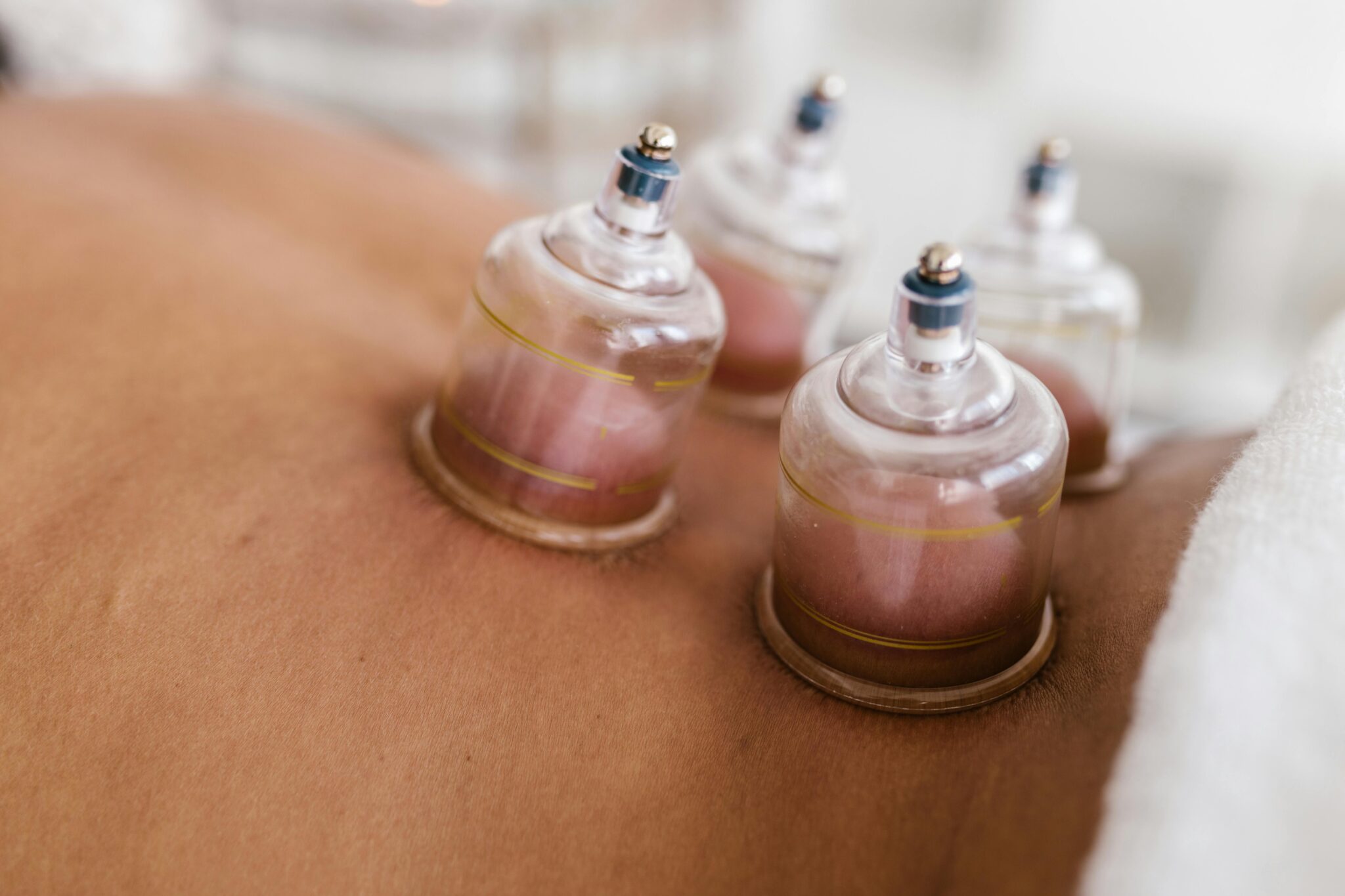 cupping therapy for acne
